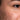 Acne Image